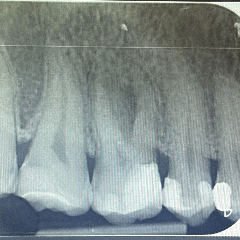 Root canal treatment before treatment