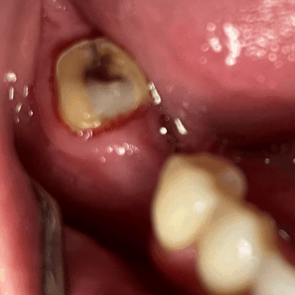 Crown Case before treatment