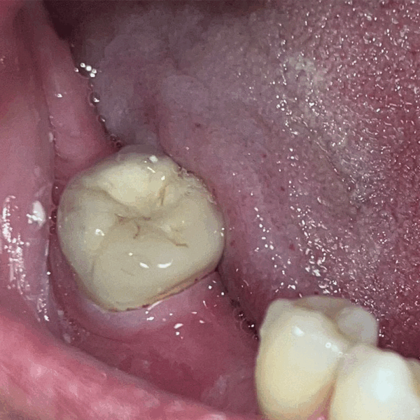 Crown Case after treatment