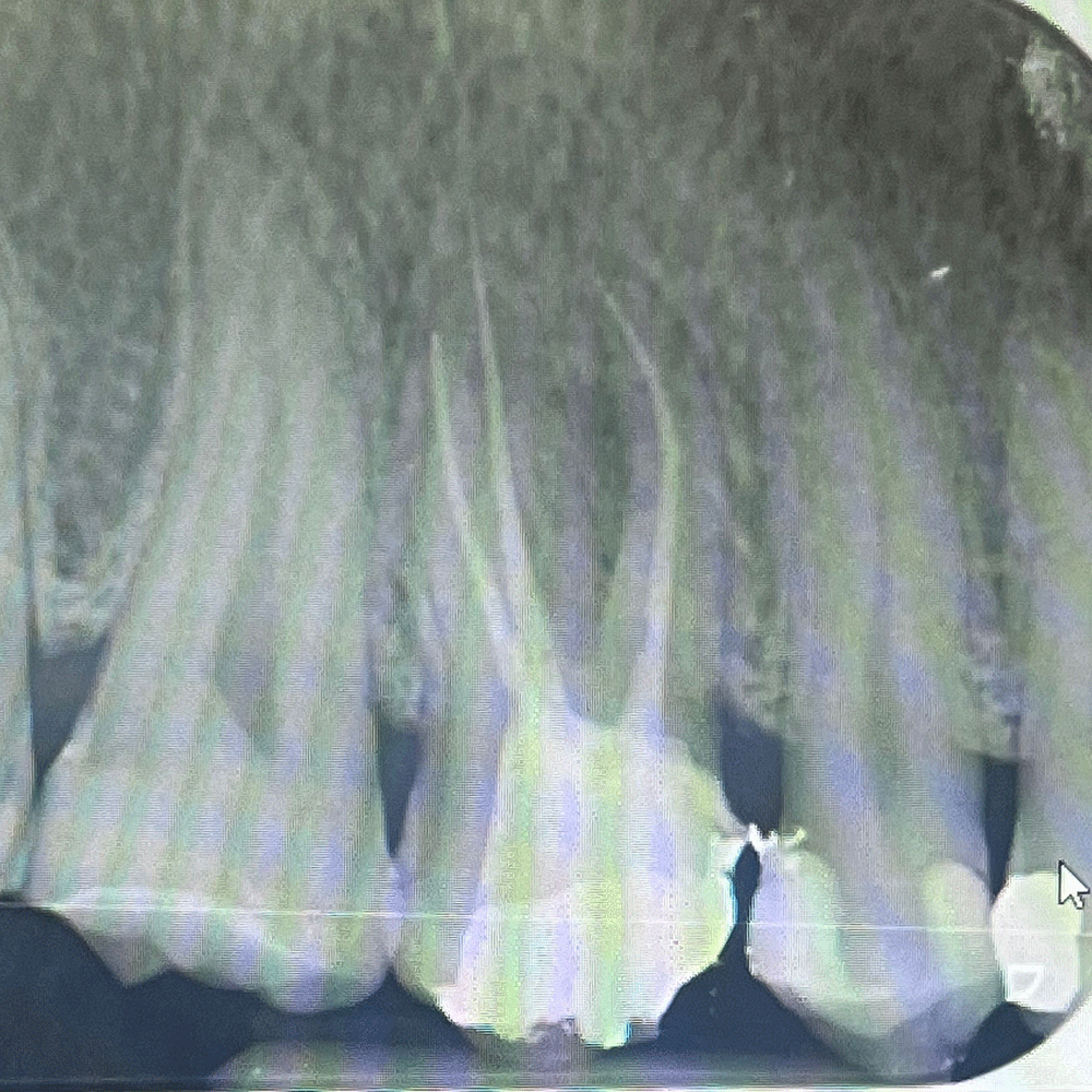 Root canal treatment after treatment