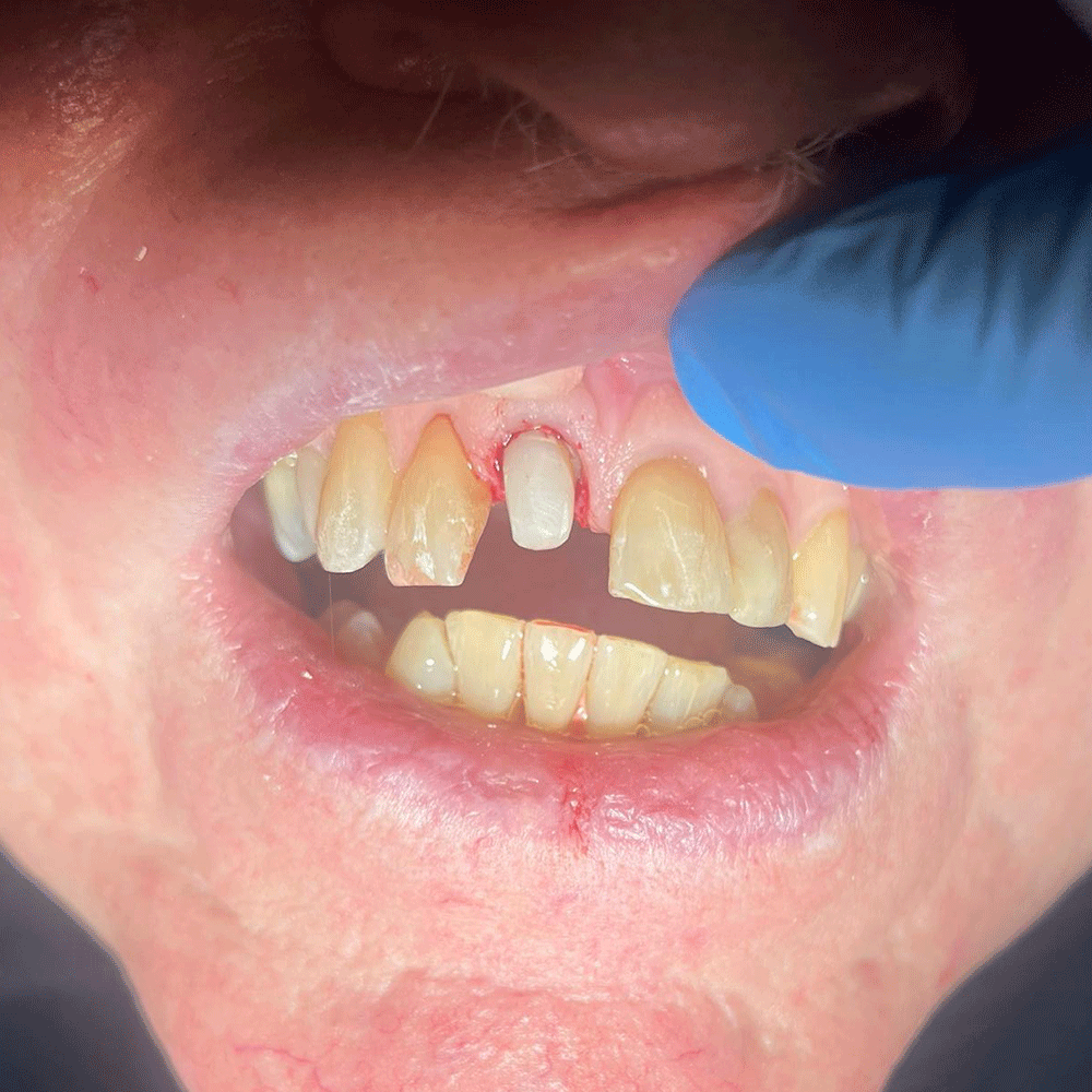 Crown restorative dentistry before treatment