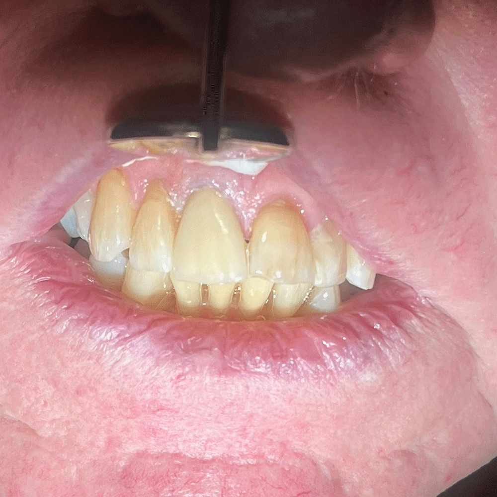 Crown restorative dentistry after treatment